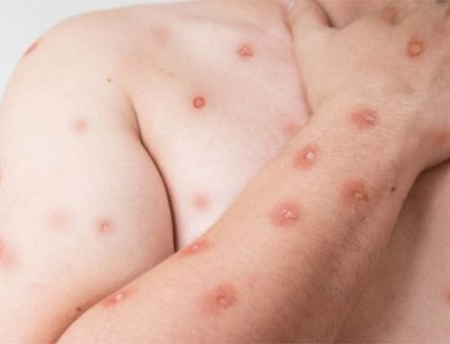 MINAS GERAIS CONFIRMOU TRÊS CASOS DE MPOX NOS DOIS PRIMEIROS MESES DE 2026